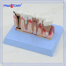 PNT-0528cc Dental Teeth Modelle und Implantate Kommunikationsmodell für Zahnarzt